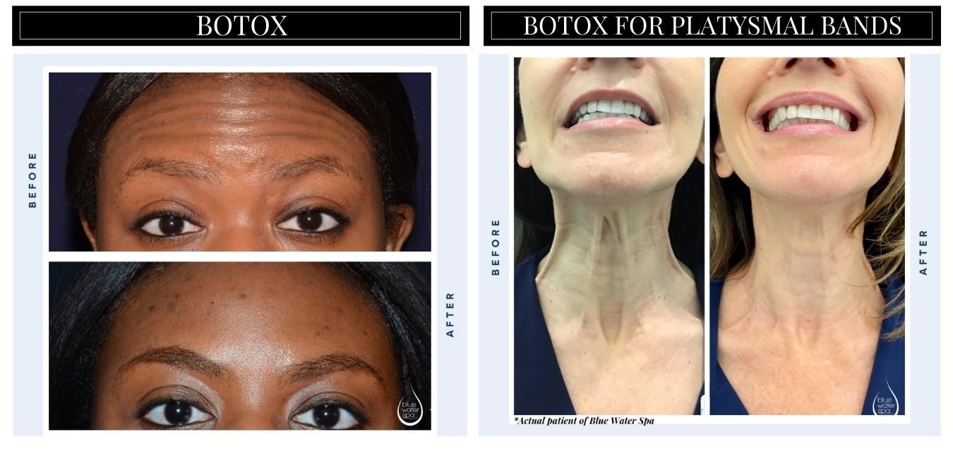 Botox BA Graphic