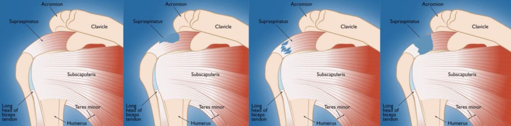 When Not to have Rotator Cuff Surgery?  Know Your Options