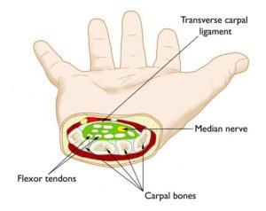 Numbness after Carpal Tunnel Surgery: 5 Causes That You Need Know