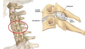 Cervicalgia: What Is Causing Your Neck Pain?