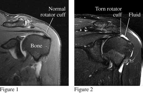MRI Images Showing Torn Rotator Cuff