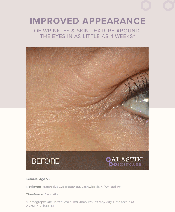 Improved appearance of wrinkles and fine lines
