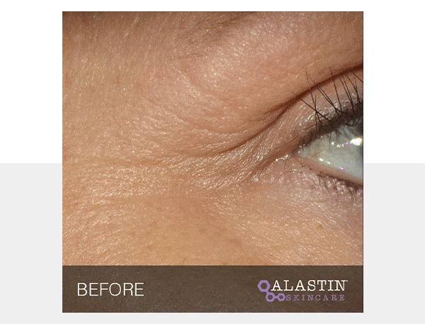 Improved appearance of wrinkles and skin texture around the eyes in as little as 4 weeks* 