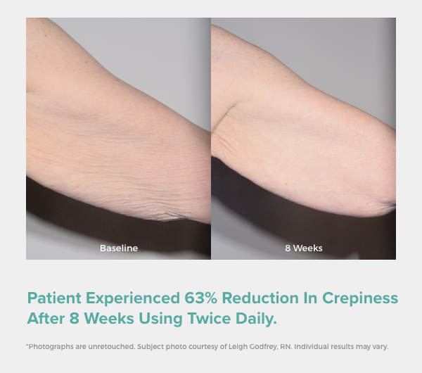 63% reduction in crepiness after 8 weeks using twice daily