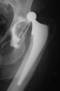 Hip Replacement Failure: 8 Reasons You Need to Know