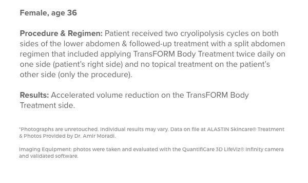 Female, age 36 Procedure & Regimen: Patient received two cryolipolysis cycles on both sides of the lower abdomen & followed-up treatment with a split abdomen regimen that included applying TransFORM Body Treatment twice daily on one side and no topical treatment on the patient’s other side (only the procedure).