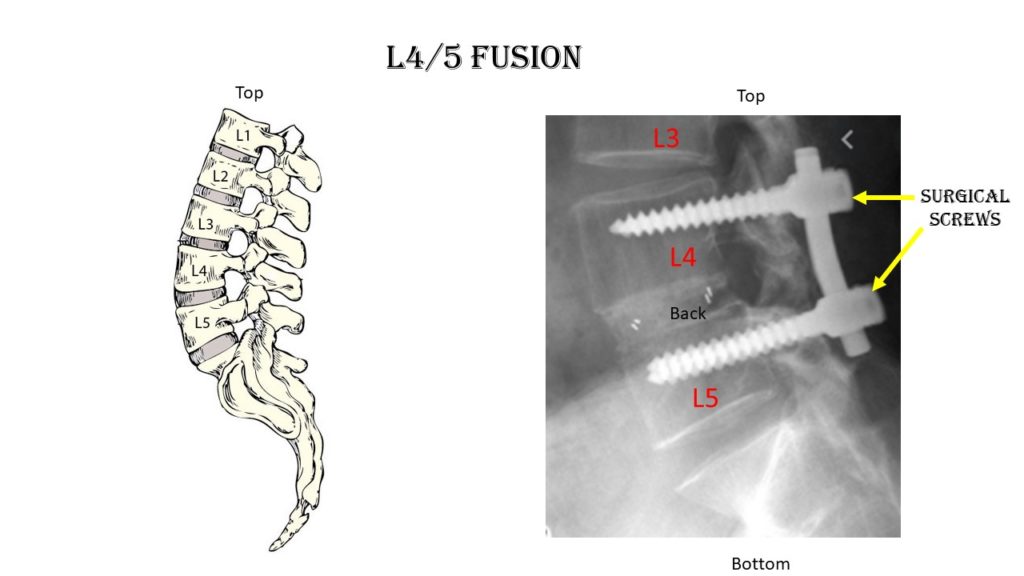 L 4/5 Fusion: A Better Understanding You Need To Know!