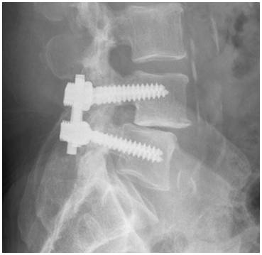 Spinal Fusion Complications Years Later?