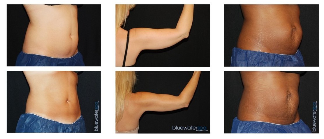 CoolSculpting at Blue Water Spa