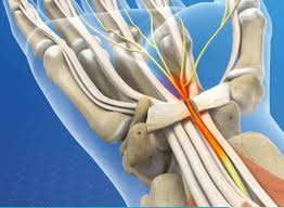 Carpal Tunnel Surgery Recovery: Facts You Need to Know Now!