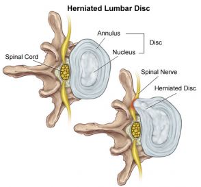 How to Heal a Herniated Disc Naturally: Know the Truth!