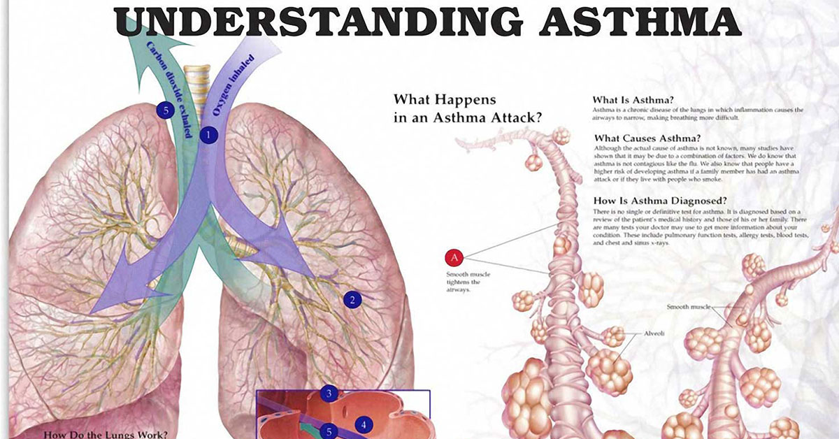 Understanding Asthma [CHART]