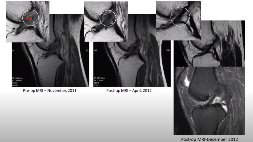 The Regenexx Perc-ACLR Procedure: Before-and-After ACL MRI Images