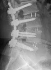 Spinal Fusion Complications Long-Term: Expert Advise You Need to Know