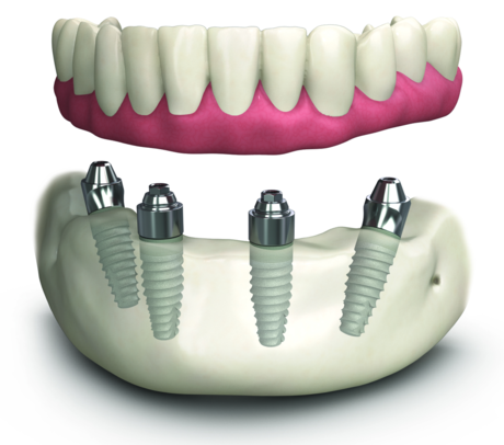 Full-arch, Immediate-load Implant Therapy