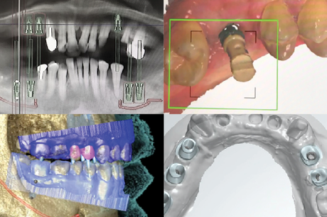 IntraOral Scanning for Implants