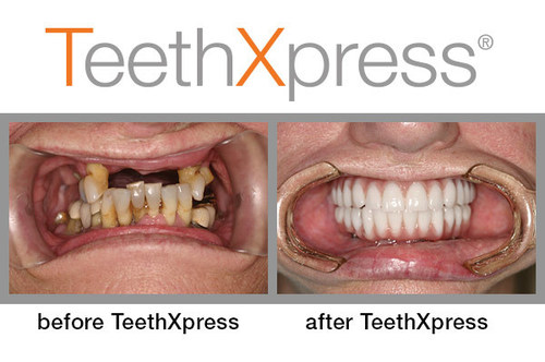 Before and after TeethXpress full-arch