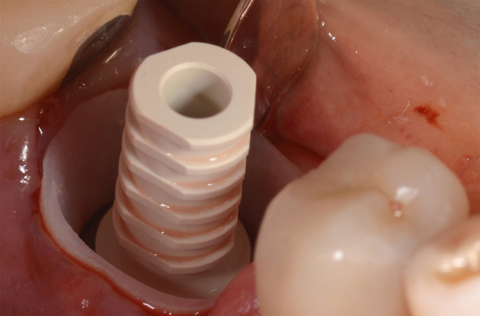 Immediate implant placement in extraction sockets with immediate temporization