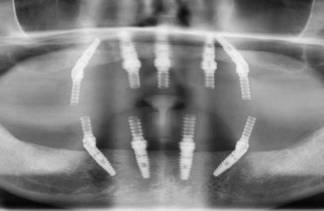 Tapered Pro dental implants radiograph